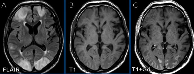 Multiple infarctions in a patient with COVID