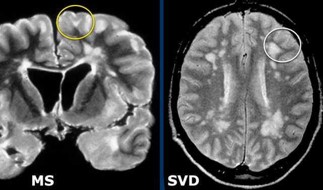 LEFT: involvement of U-fibers in MS. RIGHT: U-fibers are not involved in small vessel disease in a patient with hypertension.