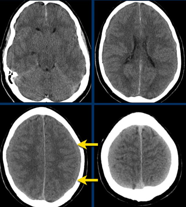 Subacute isodense subdural hematoma(3-21 days).