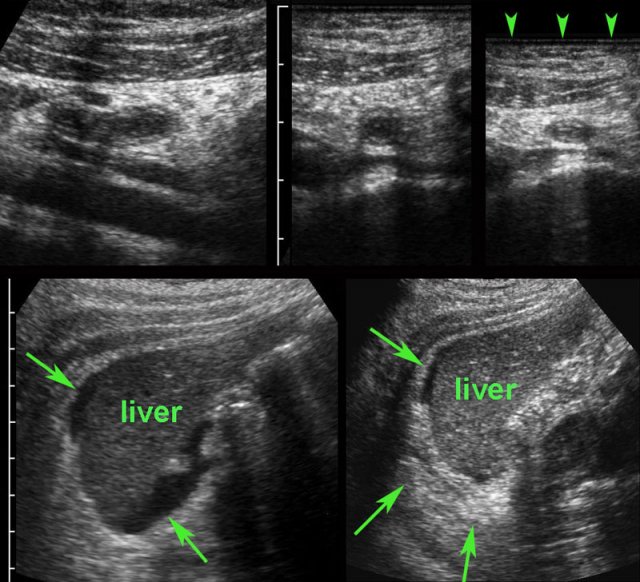 Fitz-Hugh-Curtis (FHC) with secondary thickening of the appendix.