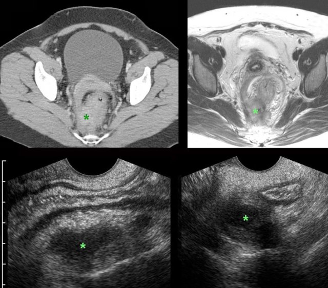 Longstanding actinomycosis mimicking DIE.