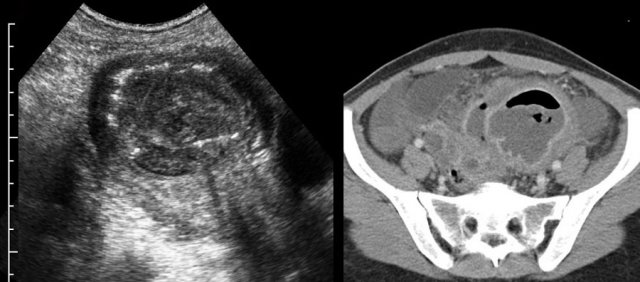 Tubo-ovarian abscess (TOA) containing gas.