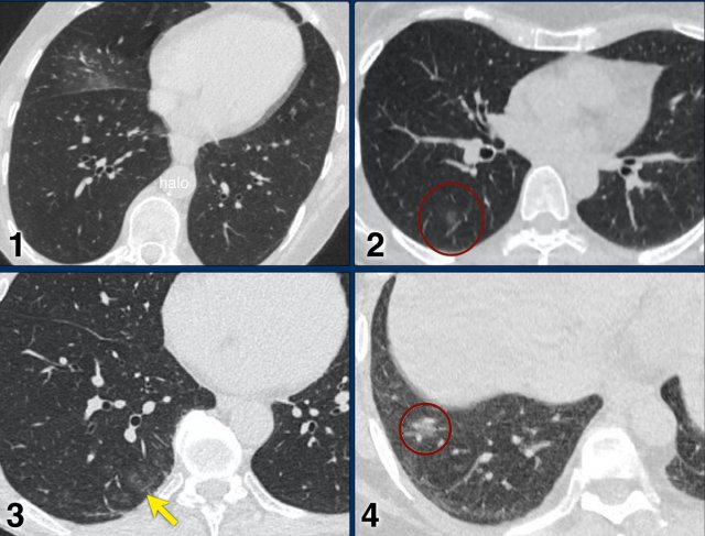 Examples of CO-RADS 3. Click to enlarge.