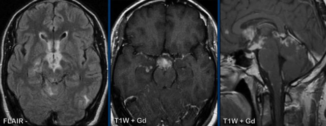 Basal meningitis