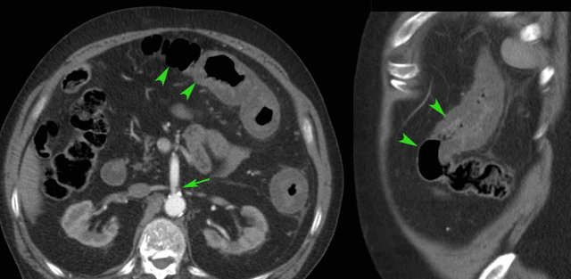 Ischemic colitis