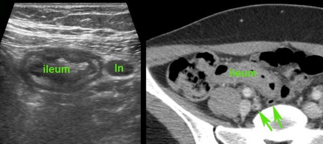 Crohn’s ileitis with enlarged mesenteric lymph nodes (ln), and a normal appendix (arrows)