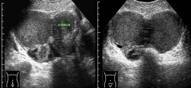 Endometriosis: chocolate cysts and “kissing ovaries”.