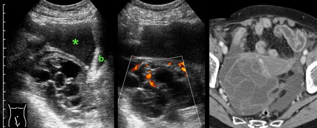 Ruptured benign mucinous cystadenoma.