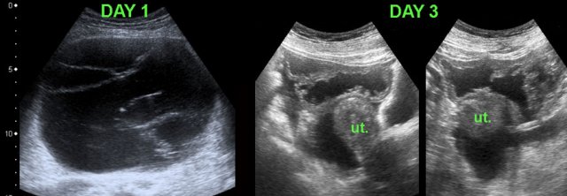 Ruptured mucinous cystadenoma. (ut. = uterus)