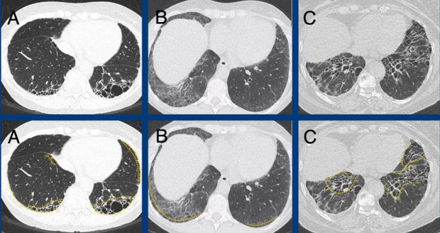 Subpleural dominant (A), subpleural sparing (B), and peribronchial dominant (C) patterns of fibrosis.