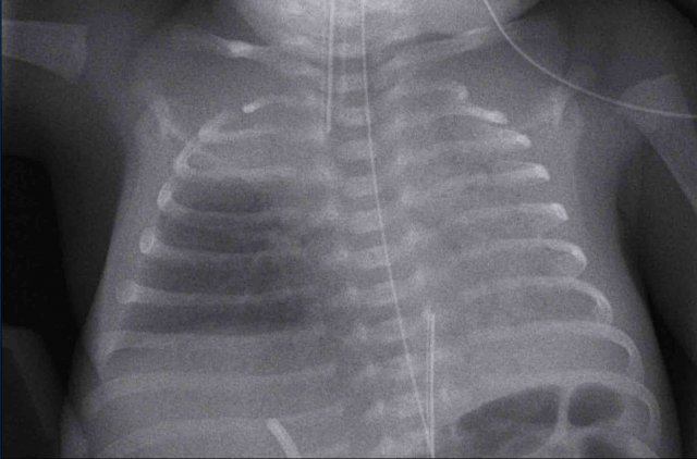 Respiratory distress syndrome - surfactant treatment