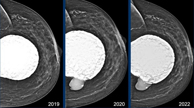 Capsular calcifications and extracapsular rupture (arrow)