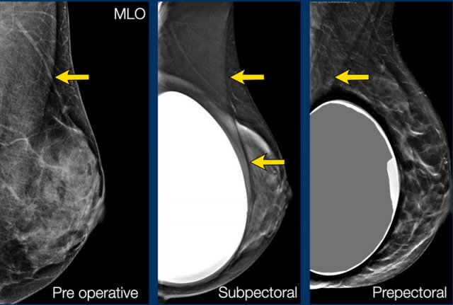 Arros indicate the pectoral muscle