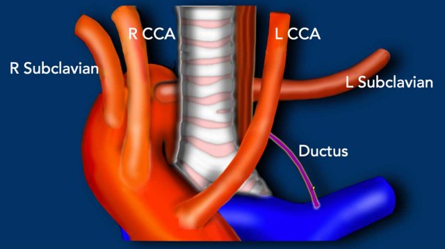 Right Aortic Arch with an aberrant left subclavian. View from anterior.