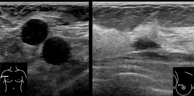 Large axillary lymph node metastases of a small irregular carcinoma