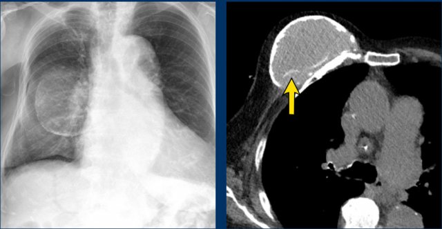 Intracapsular rupture