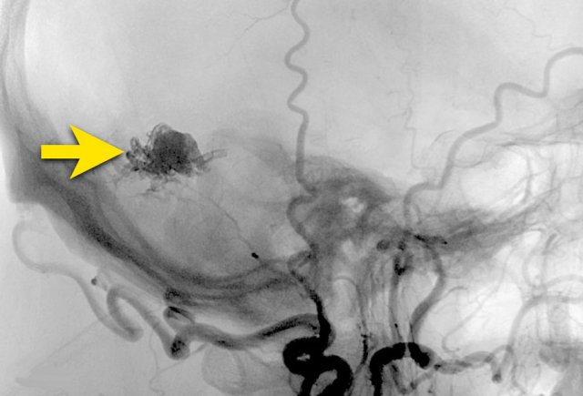 Embolization with liquid agent (arrow)