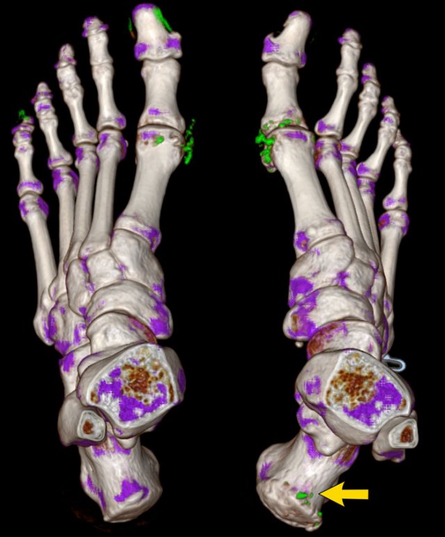 Dual Energy CT in a patient with gout and urate crystal depositions