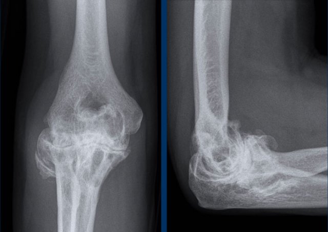 Hemophilic arthropathy