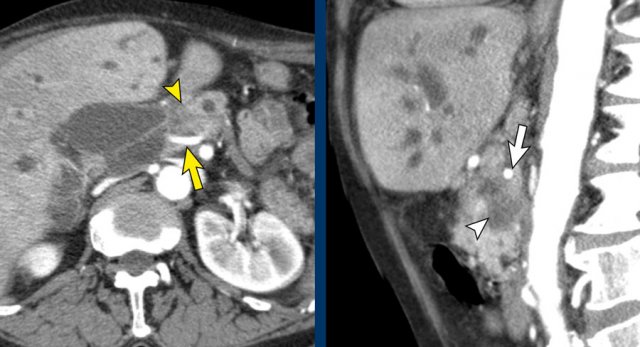 Replaced right hepatic artery