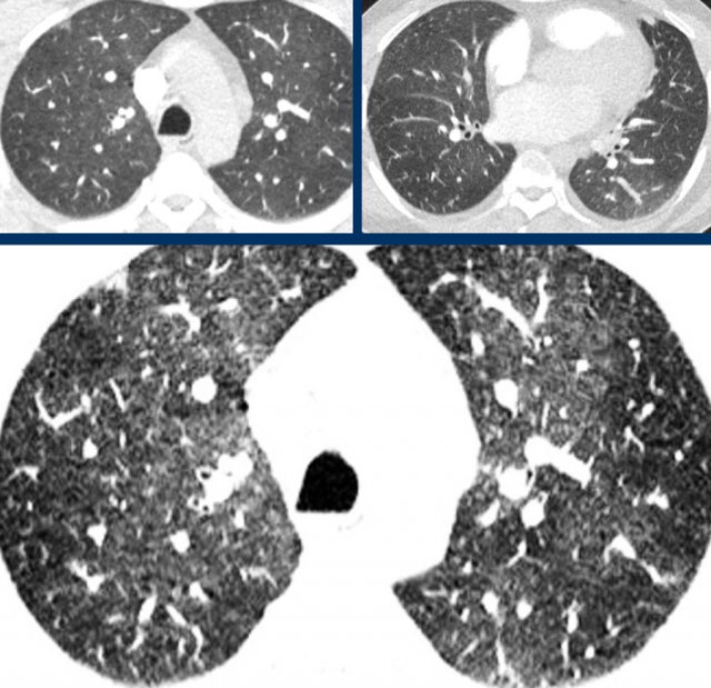 Mosaic attenutaion in a patient with bronchopathy with hypoxic vasconstriction.