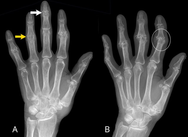 Erosive osteoarthritis in two patients