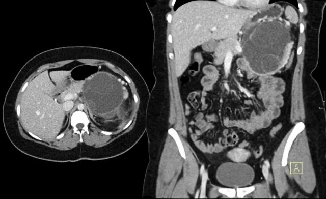 Mucinous cystadenoma.