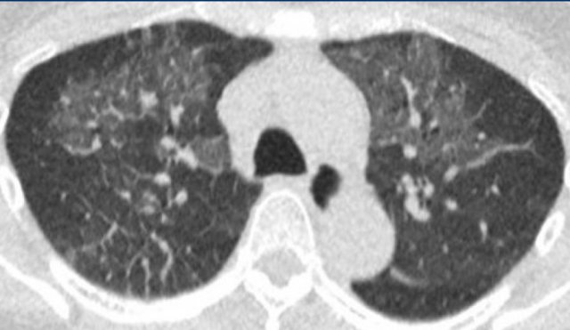 Centrally distributed  groundglass with interlobular thickening in cardiogenic edema.