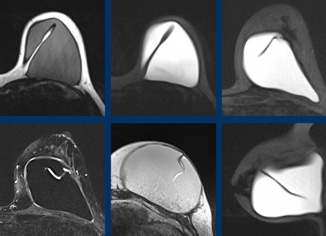 Normal radial folds