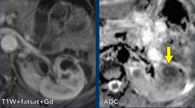 Renal abscess