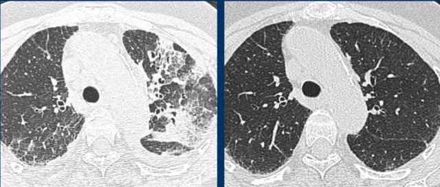 Drug-induced pneunmonitis with groundglass, reticulation, crazy paving and consolidations (left), which resolved after drug withdrawal (right).