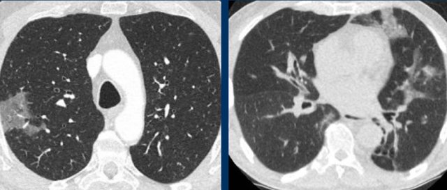 Peripheral groundglass in chronic eosinophilic pneumonia