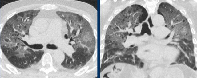 Bilateral groundglass in PCP in an immunocompromised patient.