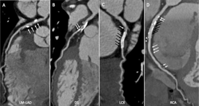 Curved MPR images of the coronary arteries.