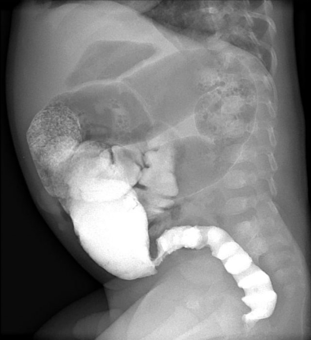 Saw tooth contractions in Hirschsprung disease