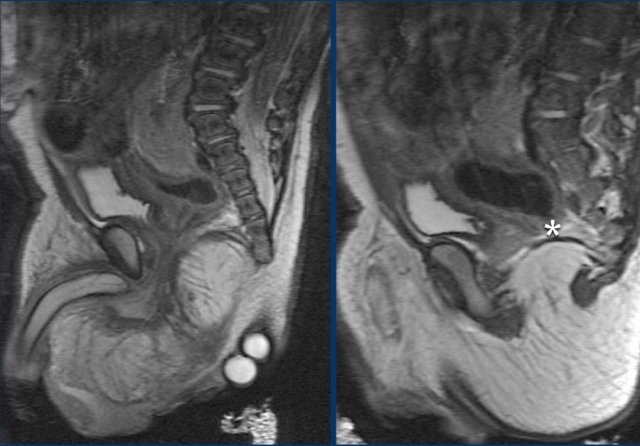 Anal atresia: markers are placed on the external sphincter. The rectum ends blind (*)