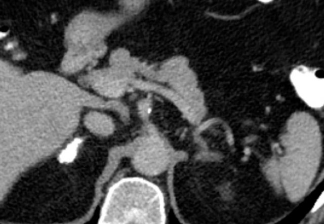 Lesions with benign calcifications