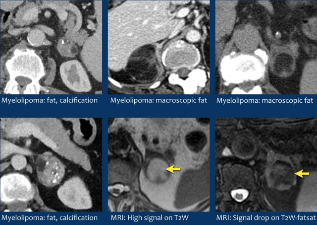 Myelolipomas