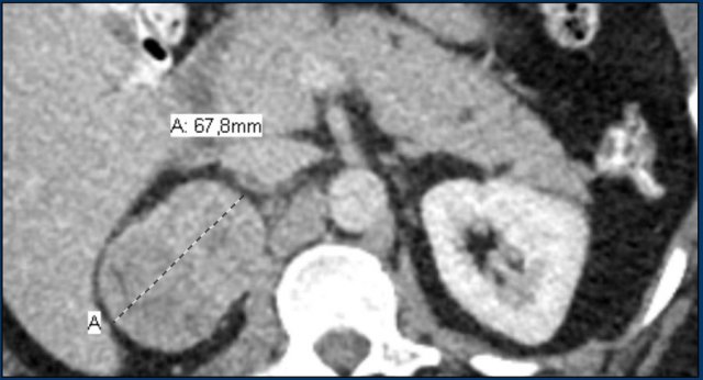 Adrenocortical carcinoma