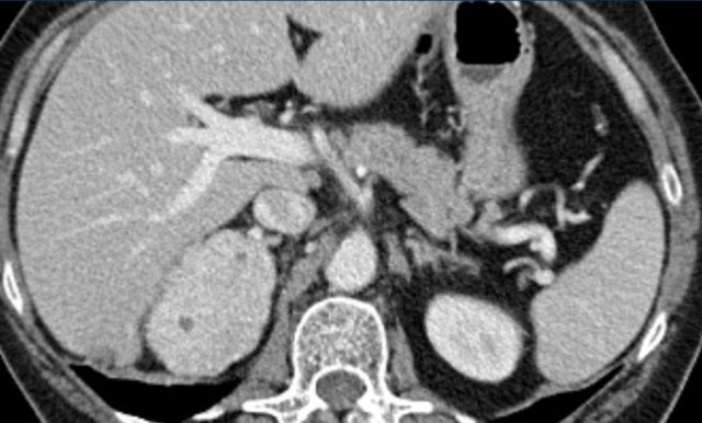 Atypical adenoma