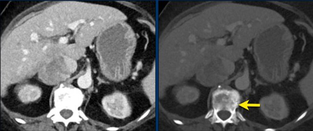 Axial venous phase CT in mediastinal and bone window setting