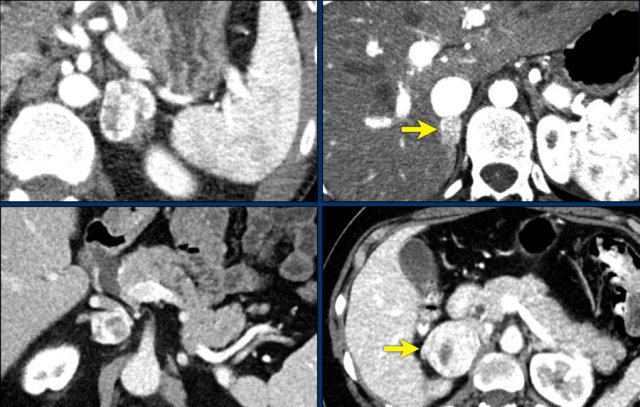 Pheochromocytomas: strong enhancement in all 4 cases, even in the smaller tumors