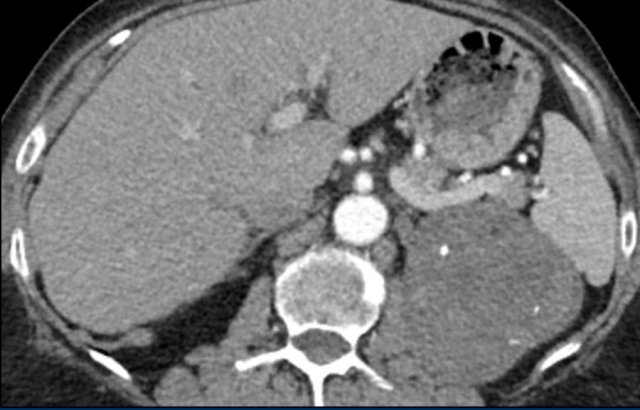 Atypical adenoma