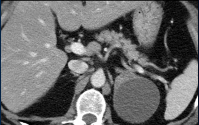 Atypical adenoma with a  post hemorrhagic pseudocyst