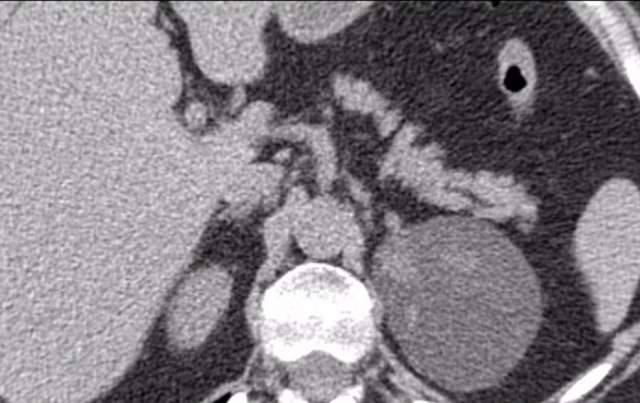 Atypical adenoma with hyperdense strands as a result of internal bleeding