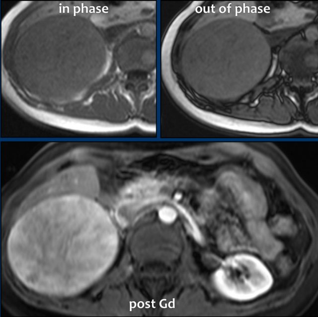 Atypical adenoma with no signal drop and heterogeneous enhancement.