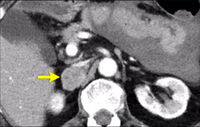 Pheochromocytoma with small cyst