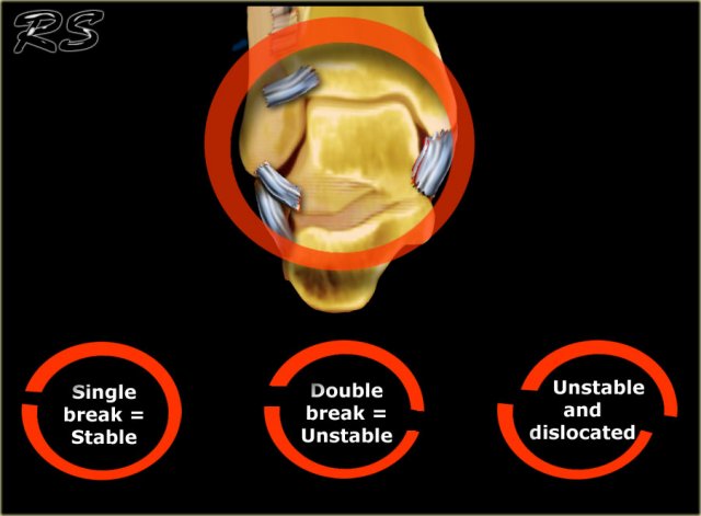 Ring of stability in the coronal plane