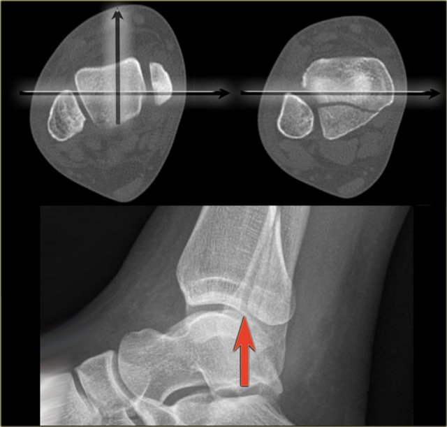 Good positioning of the lateral view - Tertius fracture