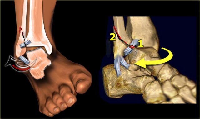 Stage 1: Rupture of anterior tibiofibular ligament - or avulsion fracture (Tilleaux)